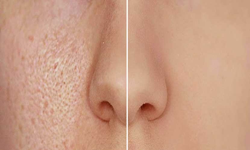 What Causes Large Pores and How Do I Treat Them?