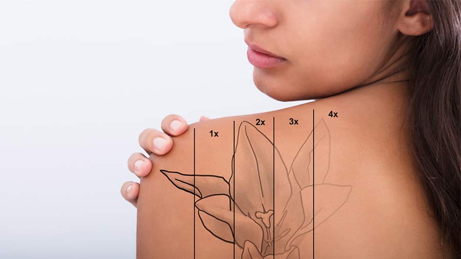 Find the Best Tattoo Removal Treatment in Pitampura Easily