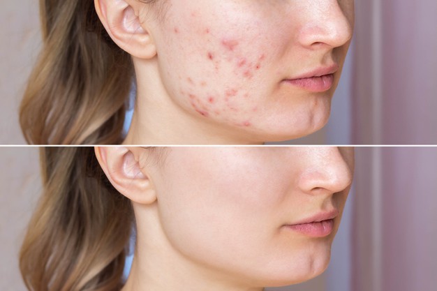 Melasma: Diagnosis and treatment - Dr. Jyoti Sharma