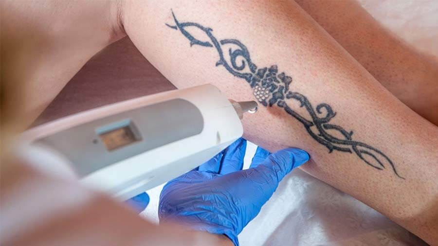 Laser Tattoo Removal Brisbane | Injex Clinics