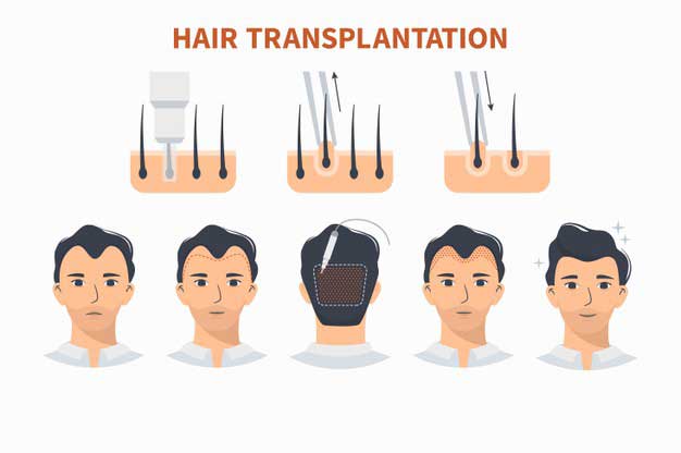 Hair Transplant solution at Dr. Jyoti Sharma [AIIMS] Dermatologist Vardaan  Clinic Pitampura Delhi
