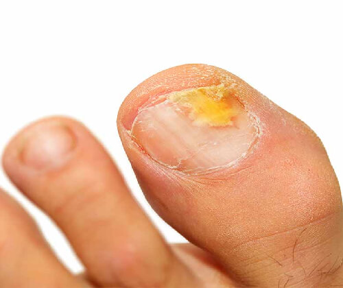 Nail Disease Treatment in Delhi