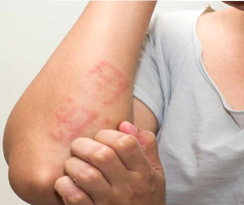 Best Eczema Treatment in Delhi