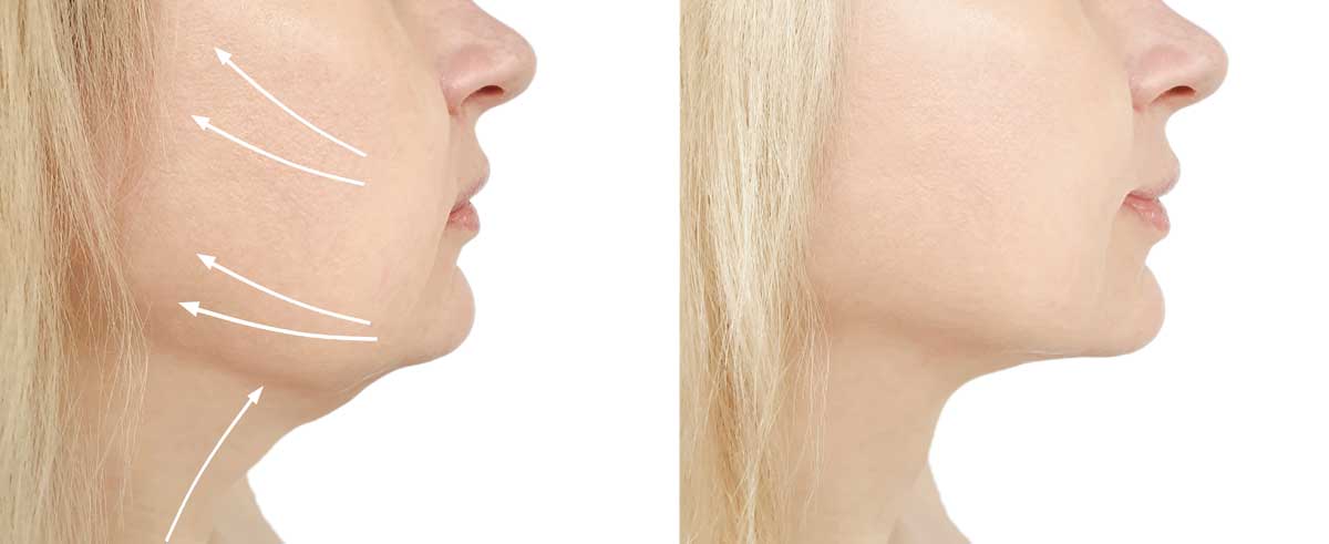 Laser Skin Tightening Treatment in Delhi