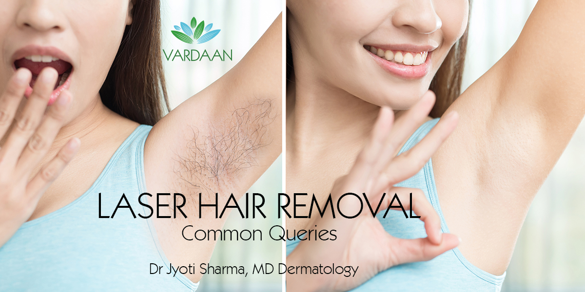 laser hair removal in delhi