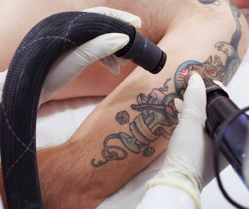 Laser Tattoo Removal in Delhi