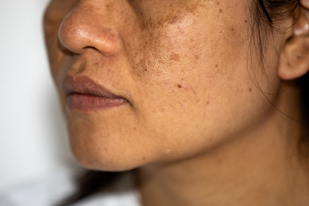 Melasma Laser Treatment  in Delhi