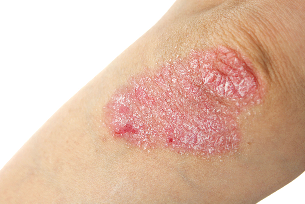 Psoriasis Treatment in Delhi