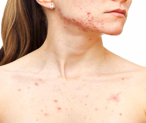 Acne Treatment in Pitampura