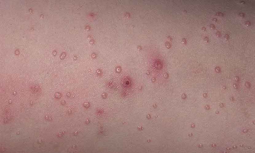 MOLLUSCUM CONTAGIOSUM