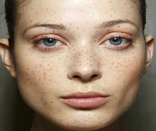 freckles removal treatment in Delhi