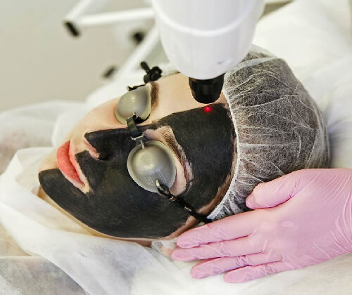 Carbon Peel Treatment in Delhi