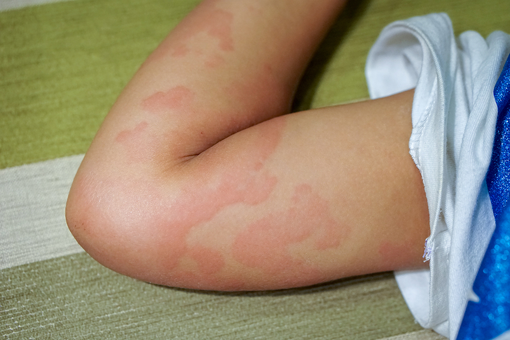 Urticaria Treatment in Delhi