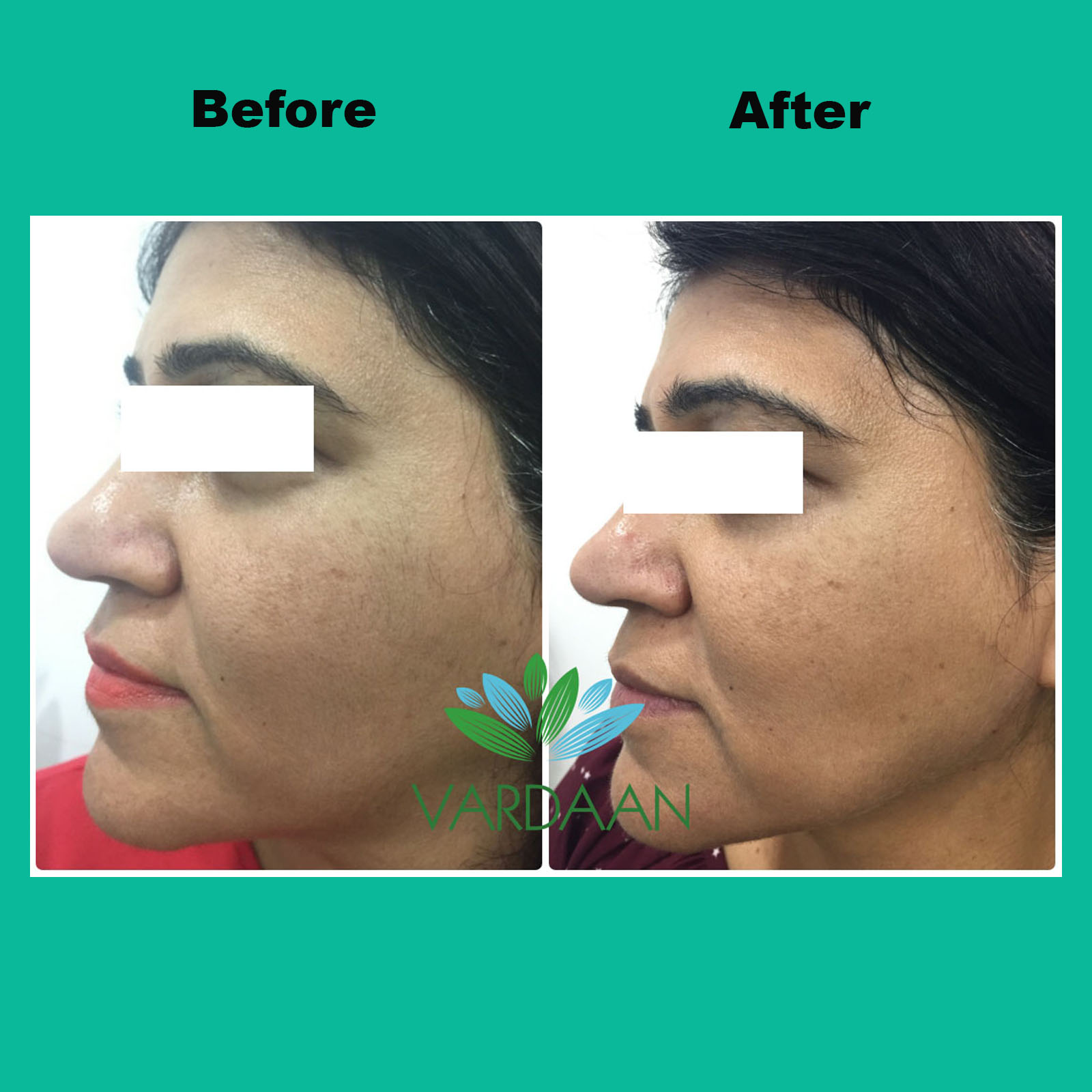 Cost Of Laser Skin Tightening Treatment In Delhi Vardaan Clinic